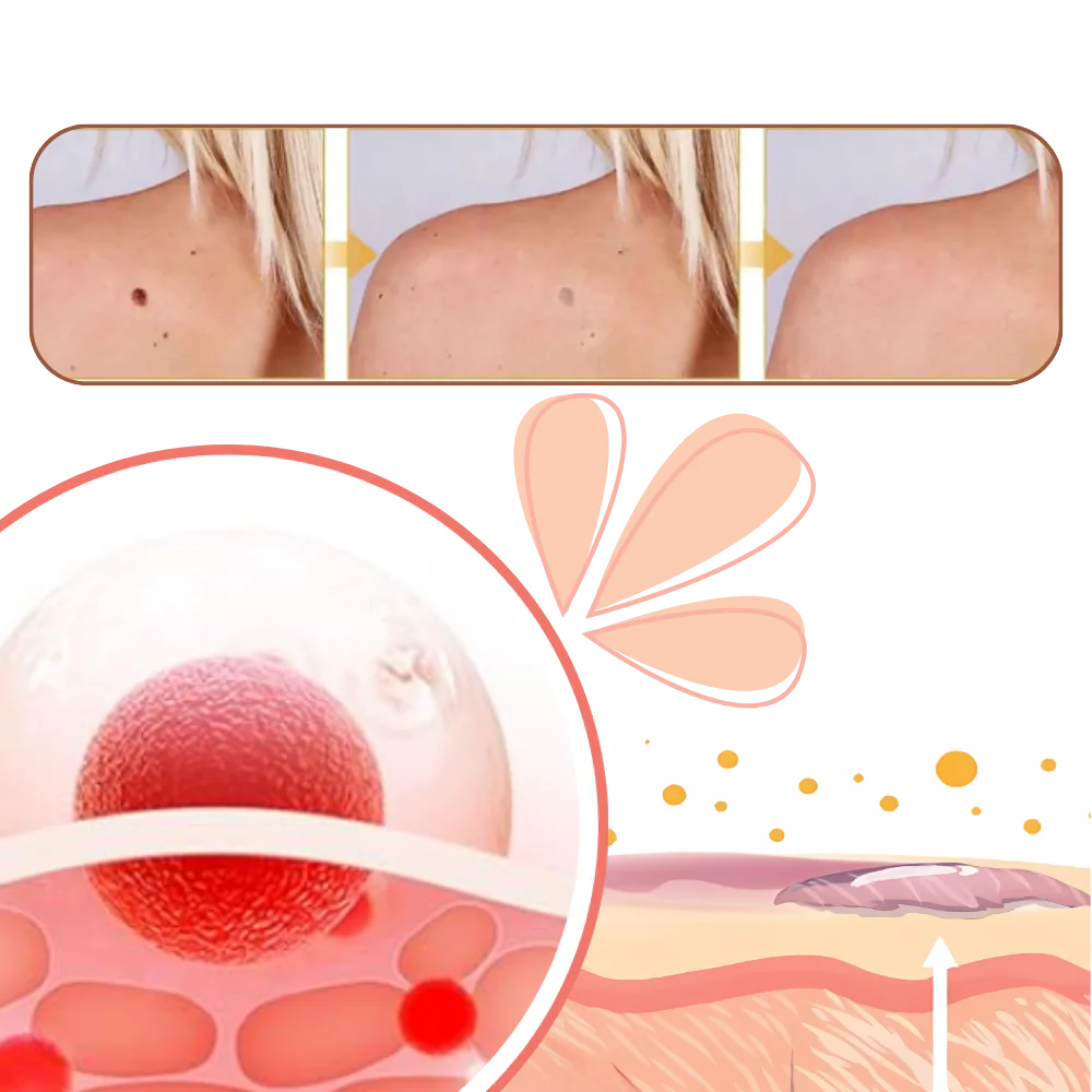 Traitement non invasif des excroissances – Image 4