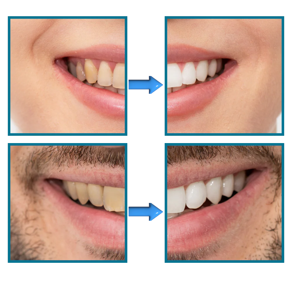 Dentifrice blanchisseur de dents et élimination rapide des taches – Image 6